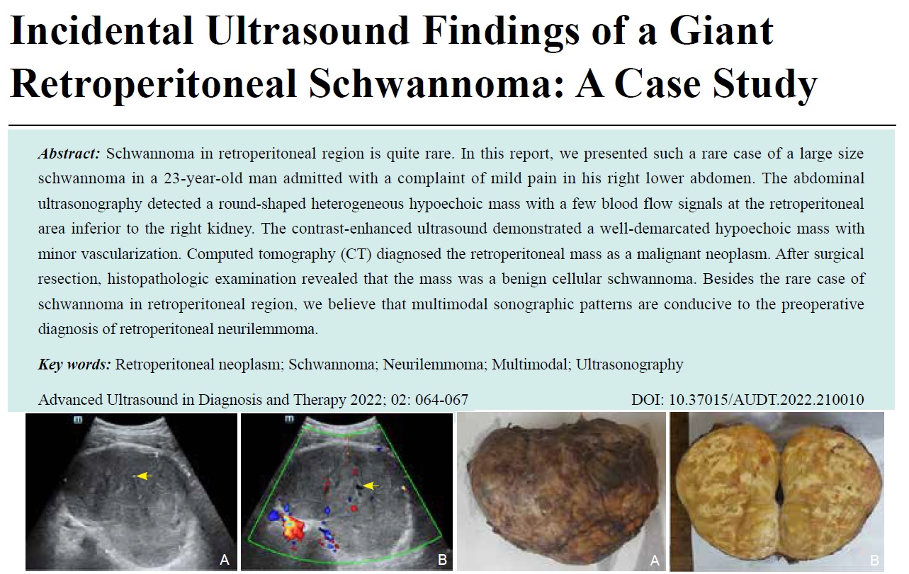 Incidental Ultrasound Findings of a Giant Retroperitoneal Schwannoma: A Case Study
