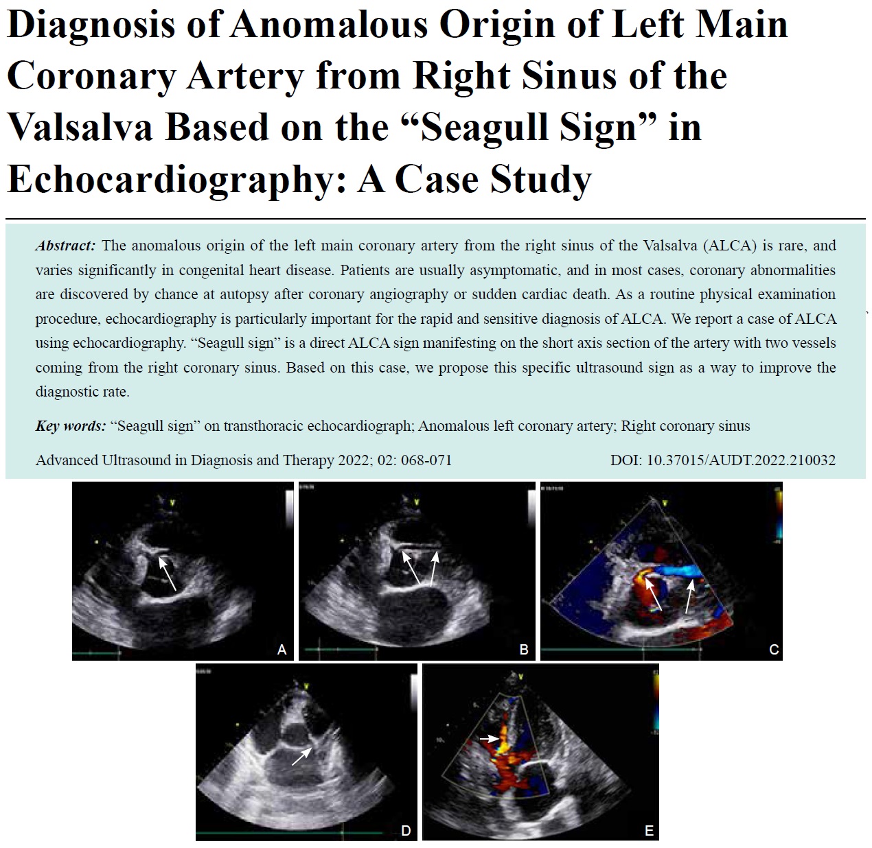 Diagnosis of Anomalous Origin of Left Main Coronary Artery from Right Sinus of the Valsalva Based on the “Seagull Sign” in Echocardiography: A Case Study