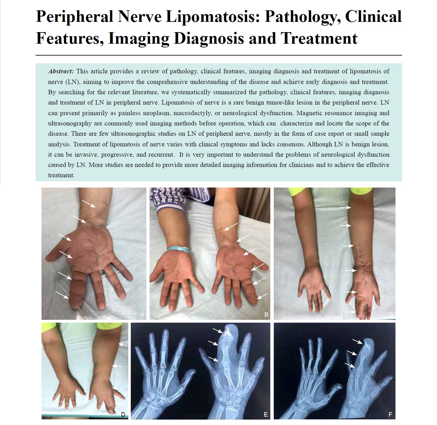 Peripheral Nerve Lipomatosis: Pathology, Clinical Features, Imaging Diagnosis and Treatmen