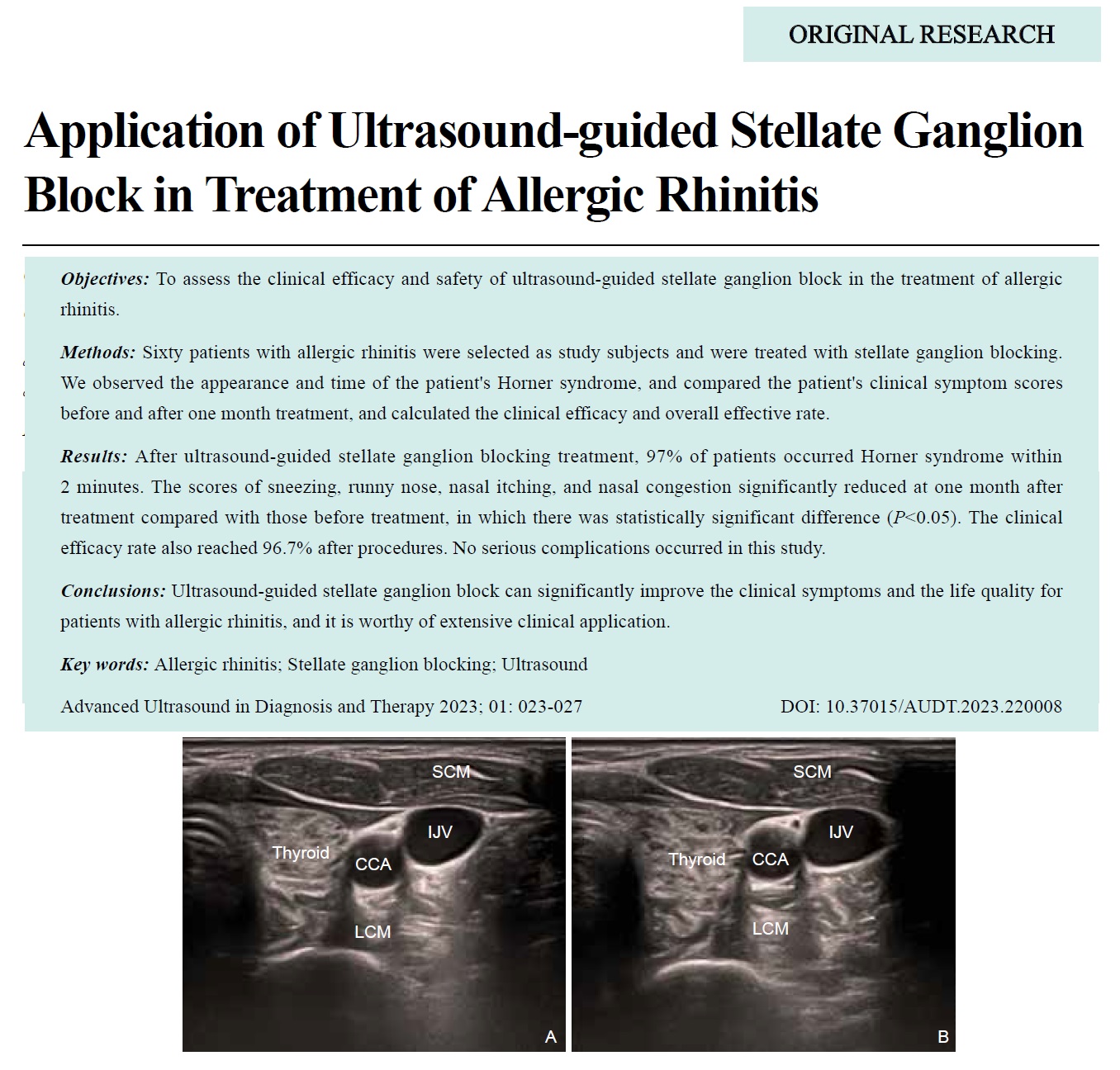 Application of Ultrasound-guided Stellate Ganglion Block in Treatment of Allergic Rhinitis
