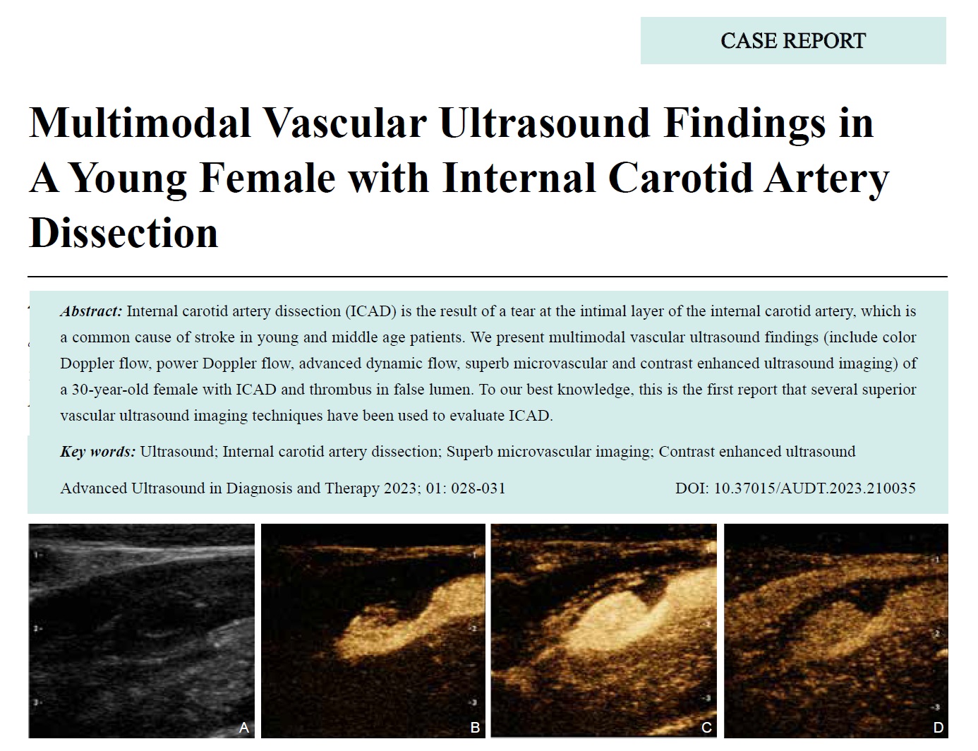 Multimodal Vascular Ultrasound Findings in A Young Female with Internal Carotid Artery Dissection