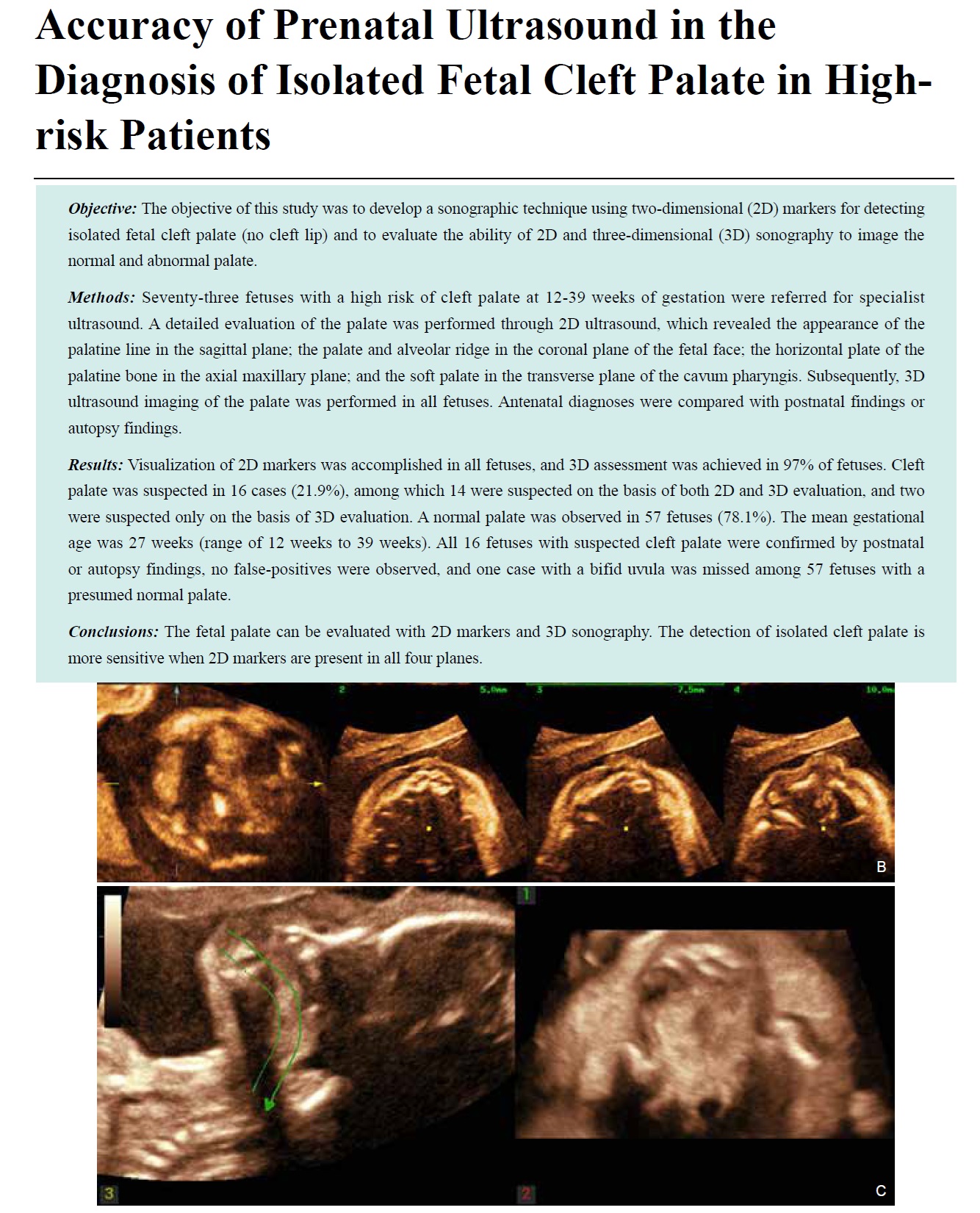 Accuracy of Prenatal Ultrasound in the Diagnosis of Isolated Fetal Cleft Palate in High-risk Patients